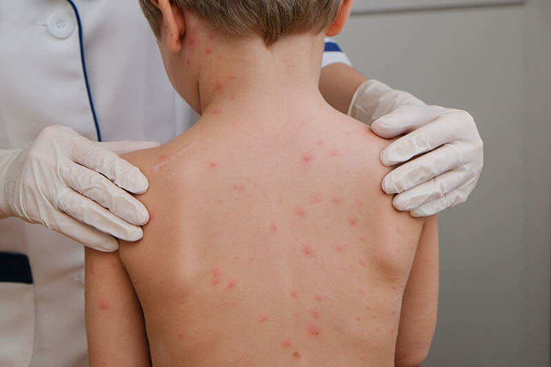 Doctor examines child's skin full of blisters and rash from chickenpox
