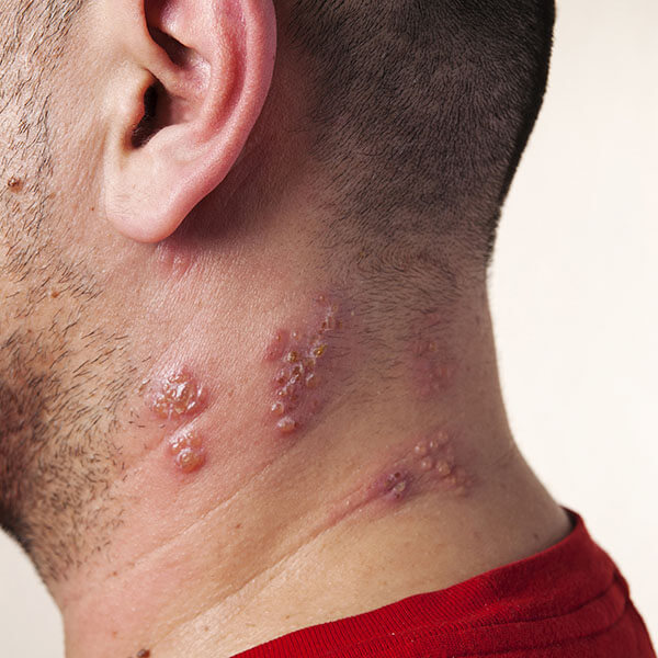 Raised red bumps and blisters caused by the shingles virus