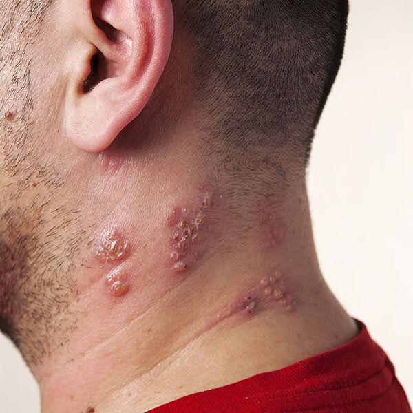 The Varicella Zoster Virus Viro Research