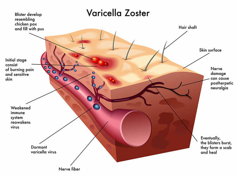 Shingles Varicella Zoster Virus Diagram - Viro Research